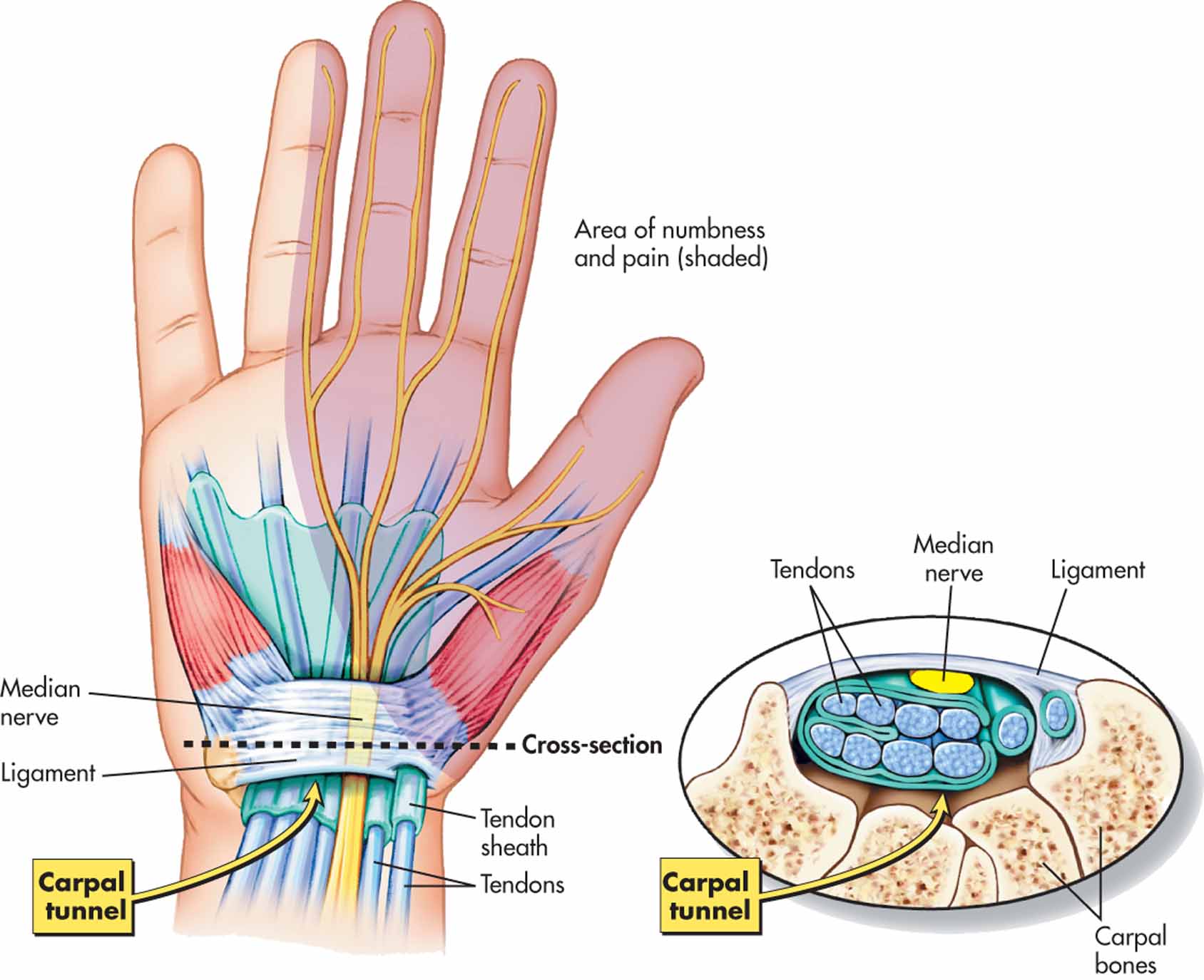 O-health - Carpal Tunnel Syndrome